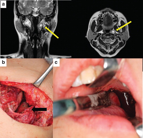 Figure 3. (a) Preoperative magnetic resonance T2 images of patient 2. (b, c) Illustrations showing patient 2 just after tumor resection. (b) Resection was achieved by using the cervical approach. The internal carotid artery was exposed (black arrow). (c) The oropharyngeal defect resulting from the resection is shown.