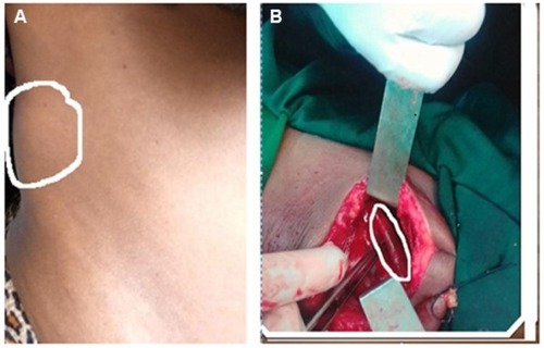 Figure 1 (A, B) Swelling or bulge on the right upper flank area (white circle).
