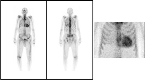 Figure 3 99mTc-HMDP whole-body scintigraphy planar image showing important myocardial uptake of the bone tracer (Perugini grade 3) which is highly suggestive of ATTR cardiac amyloidosis.