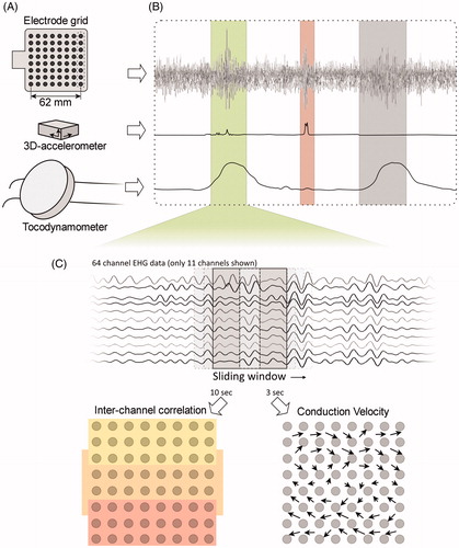 Figure 2. Schematic representation of the methods for signal analysis. The EHG was recorded using a 64-channel electrode grid (A. Sensors). The external tocodynamometer was used for identifying contractions, while the accelerometer recorded maternal movement (B. Contraction selection). Within the selected contraction segments, the mean correlation between vertical and horizontal adjacent electrode pairs was calculated for three areas of the grid, shown as the yellow, orange, and red zones. The conduction velocity was calculated in squares of four adjacent electrodes, resulting in 49 vectors (C. Multi-channel EHG analysis). Subsequently, the amplitude and angles of these vectors were averaged and the propagation was categorized as horizontal or vertical.