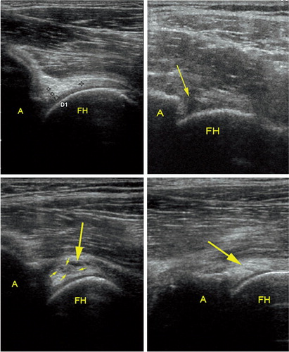 Figure 2. Ultrasound examination of the acetabular labrum. A. A normal labrum. The crosses mark the base and the apex of the labrum (“D1” marking is automatically supplied with the crosses). B. An acetabular labral tear with detachment (arrow). C. A labral tear with intra-substance cystic formation (large arrow) and a slightly irregular hypoechoic cleft (small arrows). D. An intra-substance linear labral tear (arrow). (Reproduced with permission from Troelsen et al., Acta Radiol 2007; 48: 1004-10).