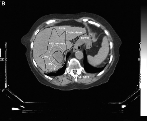 Figure 1B.  CT-planning showing the delineations corresponding to the two liver metastases in segment 7, both included in one target, the GTV arterial and venous phase, the organs at risk (liver, bowel and spinal cord), the PTV surrounded by the 65% isodose and the 33% isodose.
