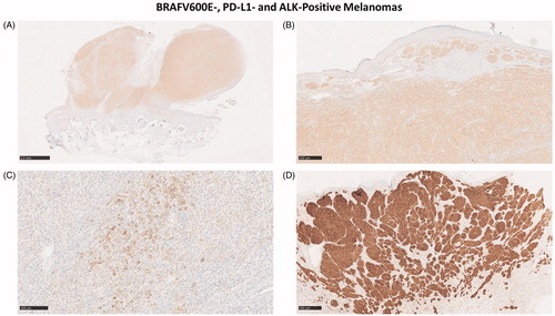 Figure 4. (A–C) BRAFV600E-positive (A, B) nodular melanoma located behind the ear of an 18-year-old male who died of metastatic melanoma. In addition to BRAFV600E, the tumor showed a weak PD-L1-positivity in <1% of the tumor cells (C). (D) ALK-positive melanoma in the foot of a 16-year-old female demonstrates the typical wedge-shaped architecture of Spitzoid melanoma.