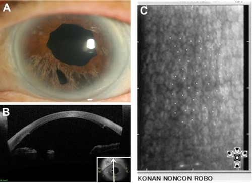 Figure 3 Slit lamp photograph, anterior segment optical coherence tomography (AS-OCT) image, and specular micrograph of the left eye after surgery. Slit lamp photograph at 6 months after nDSAEK shows that corneal edema has resolved (A). The pupil is slightly dilated with irregular margin due to sphincterotomy, and inferior iris atrophy is due to iridectomy. Other part of the iris is normal. AS-OCT image at 6 months post-nDSAEK shows adherence of the transplanted graft to recipient’s cornea, and iris defect due to iridectomy (B). Specular micrograph at 18 months post-nDSAEK shows high endothelial cell density in the center of the cornea (C).