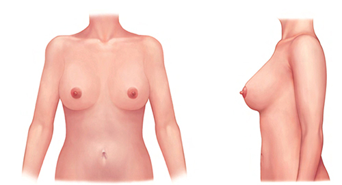 Figure 4 Ideal breast illustrations; breast proportion, nipple angle, and shape and slope of the lower pole determine breasts aesthetics. Reproduced from Lee HJ, Ock JJ. An Ideal Female Breast Shape in Balance with the Body Proportions of Asians. Plastic and reconstructive surgery Global open. 2019;7(9):e2377. The Creative Commons license does not apply to this content. Use of the material in any format is prohibited without written permission from the publisher, Wolters Kluwer Health, Inc. Please contact. permissions@lww.com for further information.Citation44
