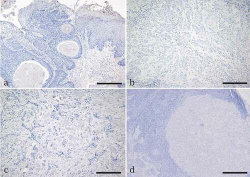 Figure 2. Immunohistochemistry assay for Napsin A expression in oral squamous cell carcinoma (OSCC). Negative expression of napsin A is seen in (a) a well-differentiated tumor and edge of the epithelium, (b) a moderately differentiated tumor, (c) a poorly differentiated tumor and (d) OSCC metastasis to neck lymph node. Scale bar = 200 µm for a, b,c. Scale bar = 50 µm for d