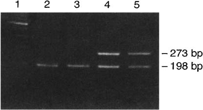Figure 1. GSTM1 genotyping. Lane 1: DNA size marker (100-bp DNA Ladder); Lanes 2 and 3: GSTM1 null genotype; Lanes 4 and 5: GSTM1 positive genotype.