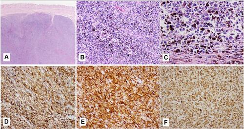 Figure 2 The histological appearance of the urinary bladder melanoma tissue was composed of solid nests and groups of atypical, poorly differentiated, highly mitotically active cells with prominent nucleoli: HE x10 (A); HE x100 (B); HE x400 (C); immunohistochemistry indicating positive reaction to HMB-45 (x100) (D); Melan-A(x100) (E) and S-100 (x100) (F).