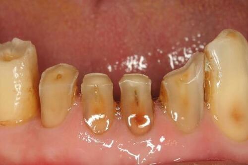 Figure 2 Severe wear of the lower incisors.