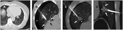 Figure 4. A. Left para cardiac nodule (circle) before treatement with RFA. B. Use of deployable needle (arrowhead) with multiple tips (white arrows) to catch the nodule (black arrow) after performing an artificial pneumothorax (asterisk). C & D. Once the needle tips (white arrows) are deployed in the nodule (asterisk), the probe (arrowhead) is retracted, in order to create a space between the heart bordert and the lesion, to reduce the heat sink effect and avoid major damages to the surrounding structures.