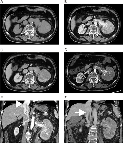Figure 1 Axial (A–D) and coronal (E–F) sections of abdominal contrast-enhanced computed tomography showing a diffusely enhanced tumor (10 cm in size) in the left kidney (plain, (A); early phase, (B); nephrographic phase, (C). The tumor thrombus extended beyond the bifurcation of the hepatic vein (white arrow, (E). After pharmacotherapy, the internal density of the tumor decreased in the early phase (D) and the tumor thrombus was significantly shortened (white arrow, (F).