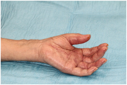 Figure 1. Photo of hands before the second synovectomy. Redness and swelling on the thumb are visible.