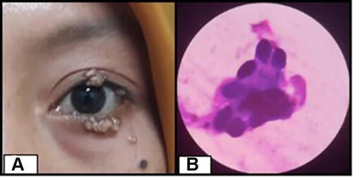Figure 3 (A) Clinical manifestation of day-1 prior to therapy, (B) molluscum bodies found in cytological examination.