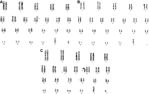 Figure 3 Representative karyotypes of exposed individual showing: (A) Fragility of the long arm of chromosome 9: 46,XY,fra(9)(q12). (B) Monosomy of chromosome X:45,X,-X. (C) Numerical and structural chromosomal alterations: 47,XY,del(8)(q23),+10,16qh+. Arrows indicate chromosomal alterations.