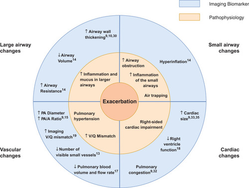 Figure 2 Summary: The Pathophysiology of a COPD Exacerbation in relation to Imaging Biomarkers. An exacerbation of COPD is associated with an increase in airway wall area and airway resistance, a decrease in airway calibre, hyperinflation, an increase in the diameter of the main pulmonary artery, a decrease in the number of visible small pulmonary vessels and cardiac enlargement. These features are suggestive of additional inflammation and mucus in the lumen of the airways, increased obstruction in the small airways and air trapping, pulmonary hypertension and right-sided cardiac impairment.