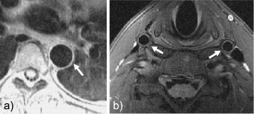 Figure 1. Dark‐blood turbo spin echo MR image of a) thoracic descending aorta and b) both common carotid arteries (images cropped for display purposes).