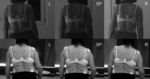 Figure 5. Changes of trunk alignment during weight shift in a healthy control subject (top) and a stroke patient (bottom). SP: The starting position (quiet standing); L: shift to the left; R: shift to the right.