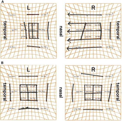 Figure 1 The Hess chart examination at the initial visit.