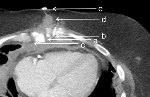 Figure 2 Axial computed tomography scan of a patient with suspected sternal wound infection 6 weeks after cardiac bypass surgery. (a) Sternal dehiscence and non-union. (b) Fragments of broken Robicsek cerclages. (c) The sternum shows fractures within itself with torn out cerclages. (d) Substernally, next to the cerclages, sporadic accumulations of air indicating an abscess. (e) Mediastinal abscess with an ascending fistula towards the skin.