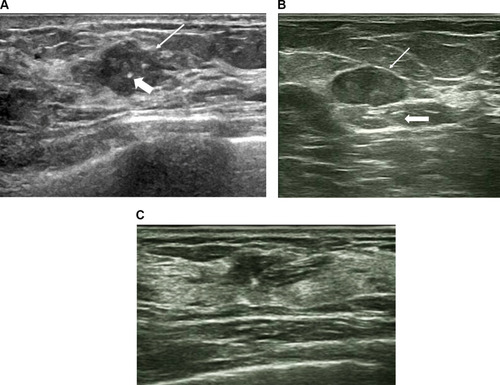 Figure 1 Representative ultrasound images showing malignant breast lesions. (A) A hypoechoic malignant lesion with irregular shape, calcification (thick arrow), and not circumscribed margin thin arrow). (B) A hypoechoic lesion with an oval shape, circumscribed margins (thin arrow), and enhancement posterior features (thick arrow). (C) A heterogeneous, hypoechoic structural disordered area with irregular shape and parallel orientation characteristic.
