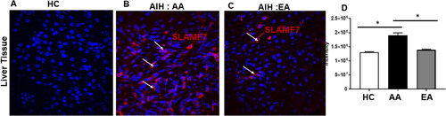 Figure 5. Signalling Lymphocytic Activation Molecule F7 (SLAMF7), a plasma cell marker is increased in AA patients with AIH: Liver tissues showing SLAMF7 staining in red and nuclear stain DAPI is in blue. Images were taken in fluorescent microscope Deltavision OMX Super resolution microscope.