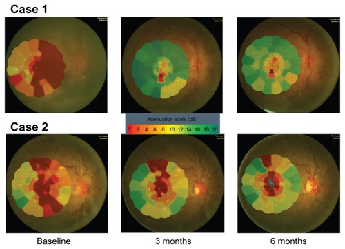 Figure 5 Macular sensitivity map obtained by microperimetry.