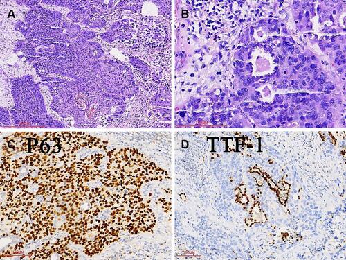 Figure 2 Cancer cells of tumor A were arranged in irregular nests (A). Alveolar architectures were preserved in cancer tissues (B). Immunohistochemical staining of tumor cells were positive for p63 (C) but negative for TTF-1 (D).
