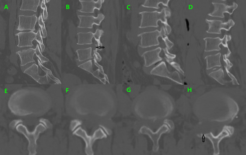 Figure 1 Postoperative sagittal reconstruction (A–D) and axial (E–H) CT image demonstrates foraminoplasty (black arrowhead) of four grades (0–3) at L4-5 level. L, lumbar.