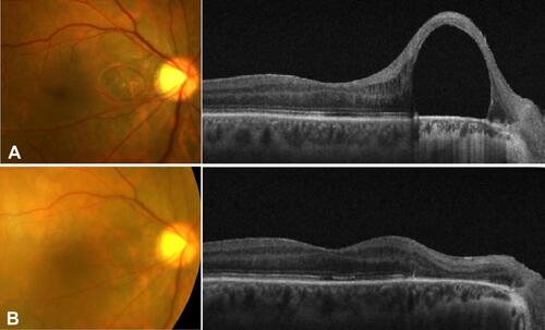 Figure 1 (A) Preoperative fundus photograph (left) and optical coherence tomography (OCT) image (right) showing a subretinal perfluorocarbon liquid (PFCL) bubble located under the papillo-macular bundle, due to a complication of retinal detachment (RD) surgery. (B) Fundus photograph (left) and OCT image (right) 2 weeks post-therapeutic inferotemporal RD induced by balanced salt solution injection, confirming displacement of the subretinal PFCL bubble with atrophy at the papillo-macular bundle.