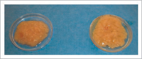 Figure 3 Gross appearance of fresh (left) and previously cryopreserved fat grafts after thawing with our preferred technique (right). The cryopreserved fat grafts have normal appearance and may possibly be used for future fat grafting if indicated. (From Pu LLQ. Cryopreservation of adipose tissue for fat grafting: Problems and potential solutions. In eds. Coleman SR, Mazzola RF. Fat injection: From Filling to Regeneration. St. Louis: Quality Medical Publishing 2009; 84).