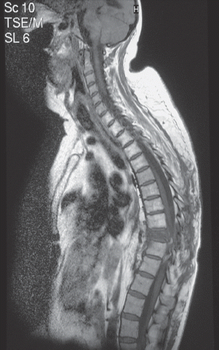 Figure 1. MRI scan of the spine demonstrating spinal cord compression at T9.