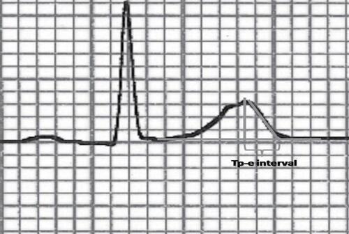 Figure 1 Measurement of the interval between the peak and the end of the T wave (Tp-e).