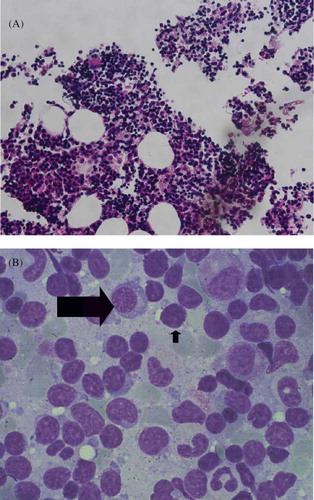 Figure 4. Bone marrow biopsy (A) predominantly mature B-lymphocytes in myeloid (hematoxylin and eosin stain, magnification ×400). (B) Increased aggregation of lymphocytes (short arrow) and plasma cells (long arrow).