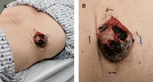 Figure 1 A dome-shaped nodule, measuring 4cm×4cm on the left back (A). Purplish red and firm, with ulceration and hemorrhagic crust (B).