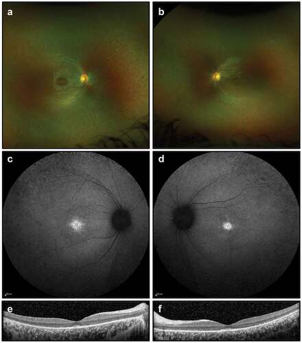 Figure 5. Retinal imaging for Case 3: (a, b) colour photographs of fundi demonstrating sparse peripheral pigment migration; (c, d) widefield FAF imaging (55 degrees) showing foveal hyper-autofluorescence; (e, f) OCT imaging showing outer retinal degeneration with some preservation of the foveal ellipsoid zone.