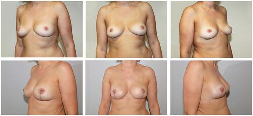 Figure 1 Pre- and postoperative photographs of a patient who underwent risk reducing NSM and simultaneous pre-pectoral implant-based breast reconstruction.