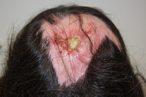 Figure 3 A severe case of EPDS large, erosive, and crusted patches with overlying and surrounding pustules and serum exudate involving the bald areas of the scalp at the vertex.