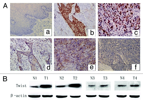 Figure 1. Expression of twist in ESCC tissues. (A) IHC analysis of twist in ESCC with or without LN metastasis. (a) Negative staining in normal esophageal tissue; (b-c) Strong nuclear staining in primary sites of metastatic ESCC cancer; (d-e) Moderate staining in the cytoplasm but negative nuclear staining in primary ESCC cancer sites without LN metastasis. (f) Negative control. (Original magnification, 200 × ). (B) WB analysis of twist expression in primary ESCC tissues (T) with or without LN metastasis and matched nontumorous tissues (N). Twist showed much higher expression in T compared with N and was stronger in primary ESCC with LN metastasis (T1, T2) than without LN metastasis (T3, T4). Four representatives are shown. β-actin was used as an internal control.