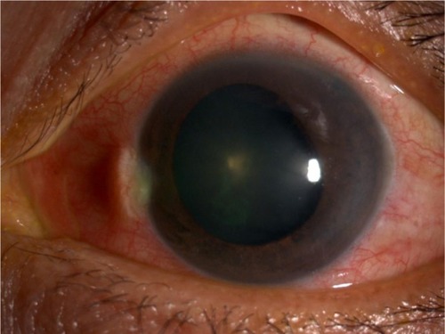 Figure 4 Acute angle closure attack due to malignant glaucoma in an eye with patent peripheral iridotomy.