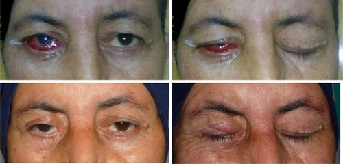 Figure 2 Patient with low level of gold plate insertion, preoperatively with eye open (above left), preoperatively with eye closed (above right), postoperatively with eye open (below left), and postoperatively with eye closed (below right).