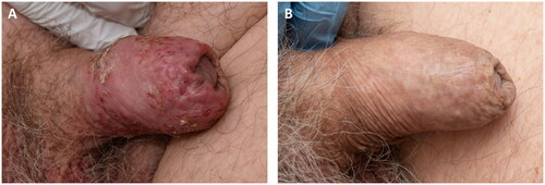 Figure 1. (A) Erythematous plaques with a slight desquamation and erosions on the penis shaft, underneath the foreskin. (B) Complete response following radiation therapy of the penis shaft, 4 Gy × 2.