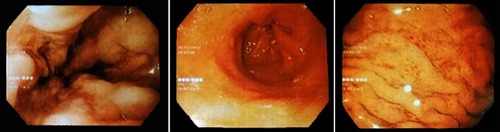 Figure 5 Esophagogastroduodenoscopy 2 months after surgery, esophageal varices grade 2 with the negative red color sign (left), cardia stomach edema (middle), and gastric snakeskin (right).