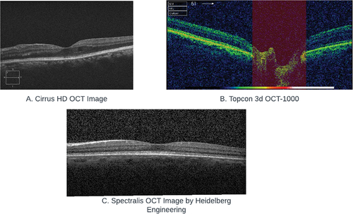 Figure 2. Comparative Samples of OCT Imaging Technologies: A. Cirrus HD OCT from OCTID, B. Topcon 3D OCT-1000 from data on OCT and fundus images, C. Spectralis OCT by Heidelberg Engineering from labeled OCT and chest X-Ray images.