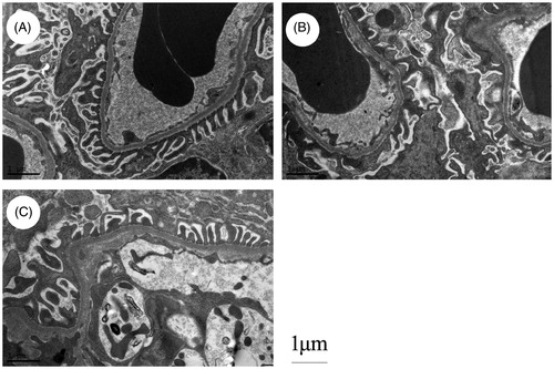 Figure 2. TAC restored podocyte process damage in 5/6 nephrectomized rats (original magnification: ×13,500). (A) Sham-operated rats showed a “zipper-like” appearance, foot processes from the cell body of podocytes regularly attached to the GBM. (B) Widespread of podocyte foot processes fusion was found in rats at 8 weeks after 5/6 nephrectomy. (C) TAC significantly prevented the fusion of podocyte foot process and maintained the “zipper-like” appearance.