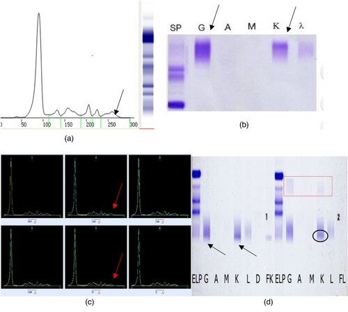 Figure 5. The results of serum protein electrophoresis, immunofixation electrophoresis, immunophenotyping and the Hydrashift 2/4 Daratumumab Assay (May 27, 2021). (A–C) shows that there maybe one M protein (the arrow points). (D) (Hydrashift 2/4 Daratumumab Assay) shows the ‘M’ protein was removed from the point of the arrow to the red box with an M protein (circled by an oval, with the immunophenotyping of κ light chain).