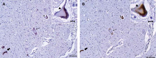 Figure 3. Correlation between ubiquitinated and TDP-43 immunoreactive cytoplasmic aggregates in ALS lower motor neurons. (A) Ubiquitinated aggregates in three separate motor neurons. (B) TDP-43 immunoreactive aggregates in the adjacent section showing corresponding changes (respective arrows). The morphological appearances are similar between ubiquitinated and TDP-43 immunostaining; inlays show respective magnified images (arrowhead).