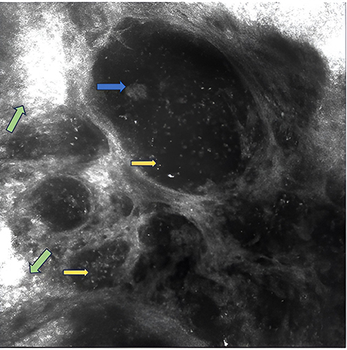 Figure 1 Reflectance confocal microscopy (RCM) image depicting a fragment from an acute eczematous lesion located on the lateral side of hand. The capture shows multiple vesicles (dark round masses) filled with inflammatory cells (yellow arrows) and grey shadows as keratinocytes (blue arrow). Surrounding the vesicles the epidermis has a disarranged cobble stone pattern (green arrows).