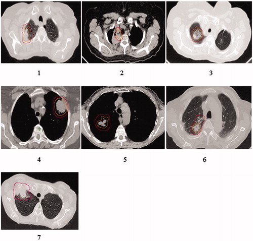 Figure 3. Dose-planning CT-scans of the patients with brachial toxicity. All these patients except for patient number 5 had a PTV-plexus distance of ≤2 mm and received BED3,max between 177–524 Gy. The same patient numbers (1–7) are also valid for Table 2 and Supplementary Figure 1.