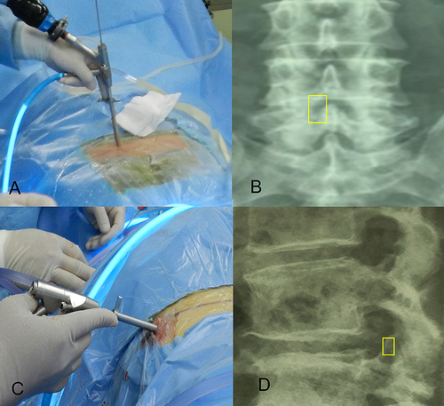 Figure 3 The entry point and osteotomy range of interlaminar and transforaminal techniques. (A) The entry point of interlaminar technique was above the corresponding lamina space and 2–3 cm from the midline. (B) The range of translaminar space in interlaminar technique did not exceed the outer edge of the nerve root and the attachment point of ligamentum flavum. The yellow box indicates the extent of facet joint and ligamentum flavum resection in ILT. (C) The entry point of transforaminal technique was 8–12 cm from the midline. (D) The grinding ratio of the superior articular process was limited to less than 25%. The yellow box indicates the range of removal of upper articular process in TFT.