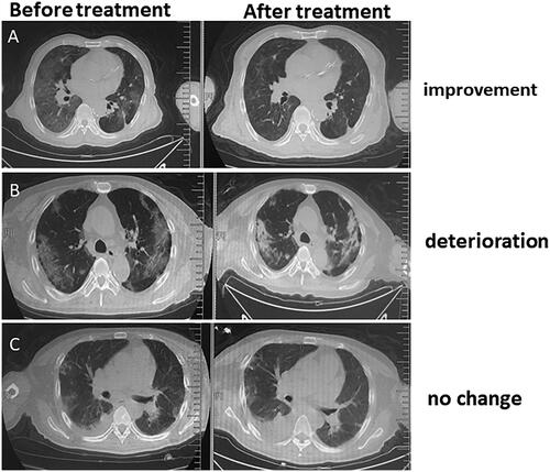 Figure 3. Typical CT scanning imaging features for HD patients infected with COVID-19 before and after treatment. (A) Improvement; (B) deterioration; (C) no change.